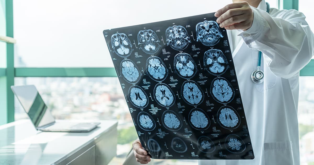 La maladie d'Alzheimer