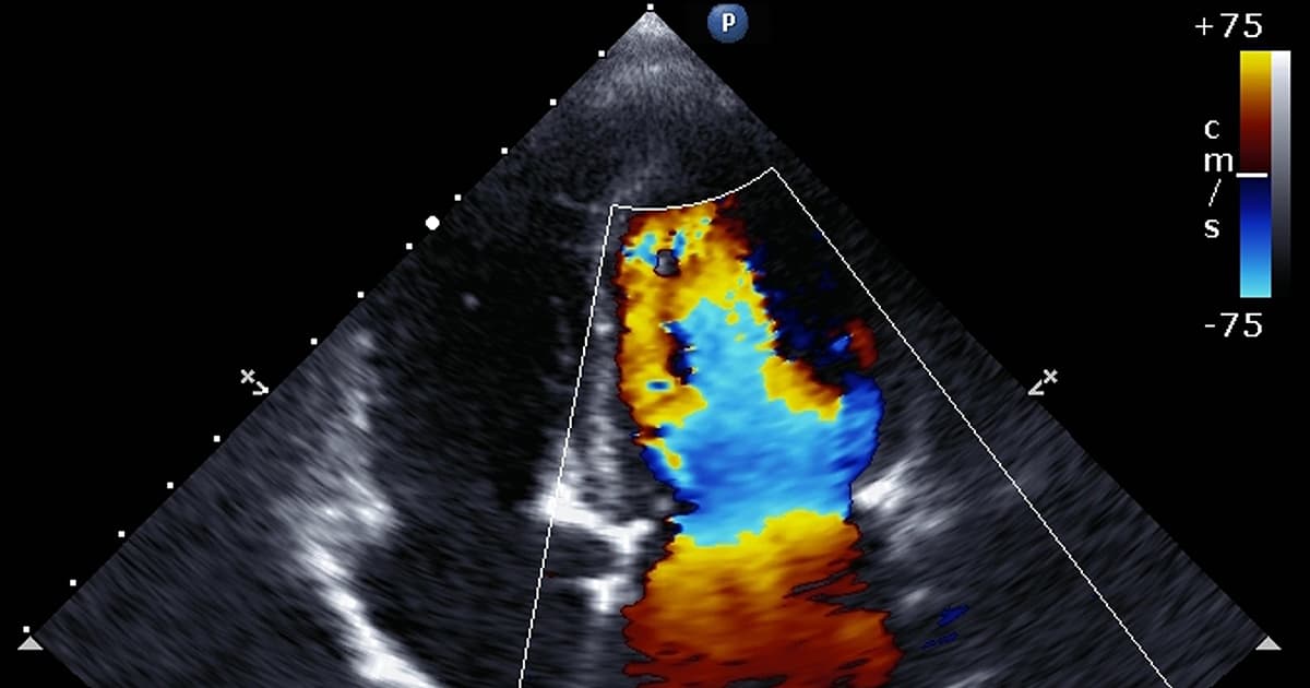 Les échocardiogrammes