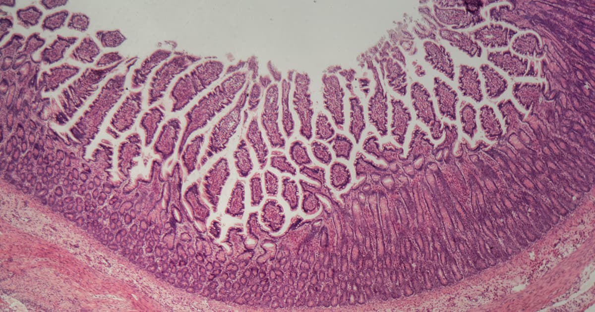 Les maladies inflammatoires de l'intestin